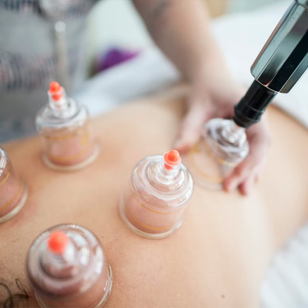Myofascial Cupping Treatment near Jimboomba